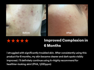 glutathione acne before and after 7 Dark Spot Serum PURCELL 88B/mL L-Glutathione Flexible Liposome
